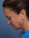 before facelift neck lift left side head down view female patient case 1602