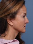 after facelift neck lift right side view female patient case 1602