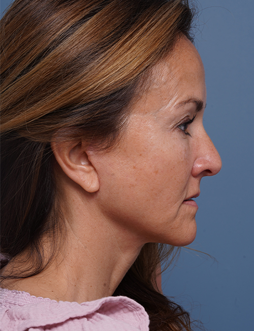 after facelift neck lift right side view female patient case 1602