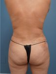 back view of female patient after mommy makeover case 1624 Palm Beach, FL