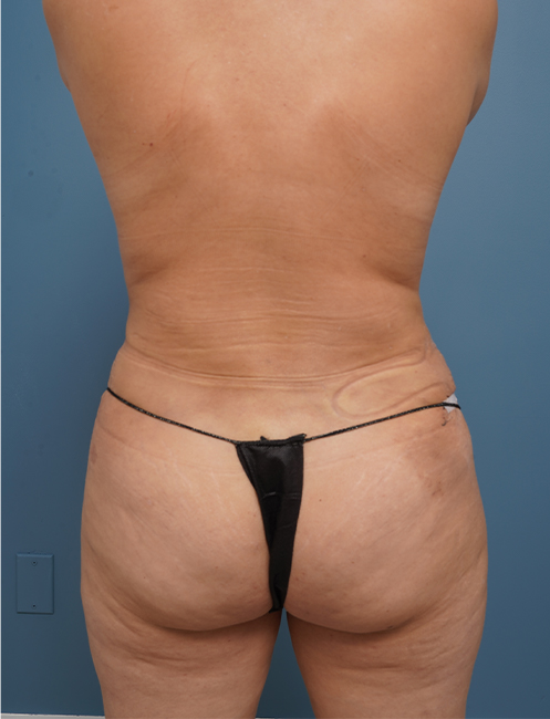 back view of female patient after mommy makeover case 1624 Palm Beach, FL