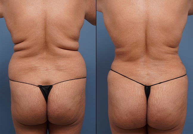 before and after back view of female patient after mommy makeover case 1672 Palm Beach, FL