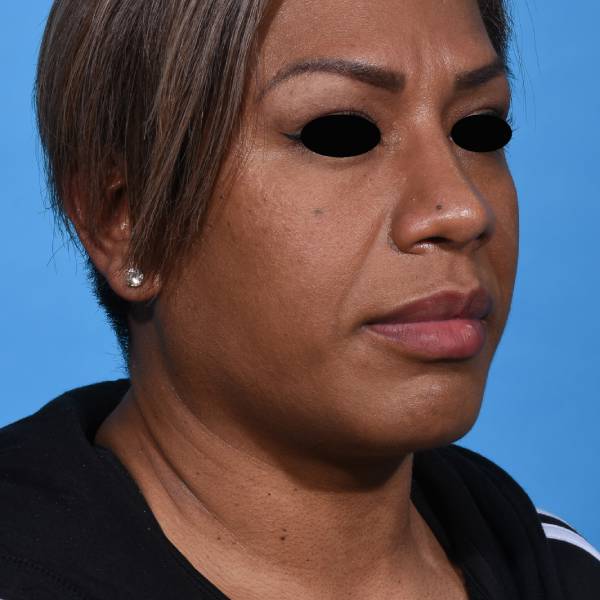 after rhinoplasty right angle view female patient case 1221