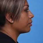 after rhinoplasty right side view female patient case 1221