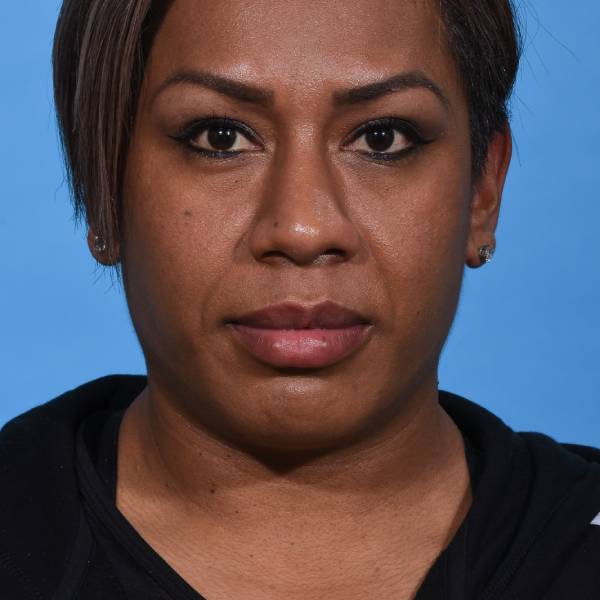 after rhinoplasty front view female patient case 1221