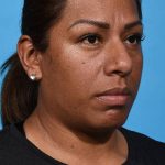 before rhinoplasty right angle view female patient case 1221