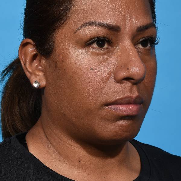 before rhinoplasty right angle view female patient case 1221