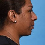 before rhinoplasty right side view female patient case 1221