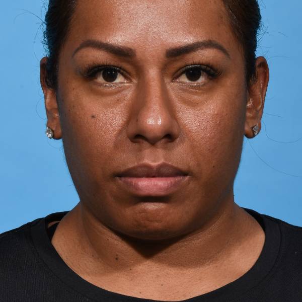 before rhinoplasty front view female patient case 1221