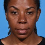 after rhinoplasty front view female patient case 1228