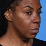 after rhinoplasty right angle view female patient case 1228