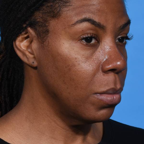 after rhinoplasty right angle view female patient case 1228