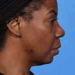 after rhinoplasty right side view female patient case 1228