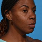 before rhinoplasty right angle view female patient case 1228