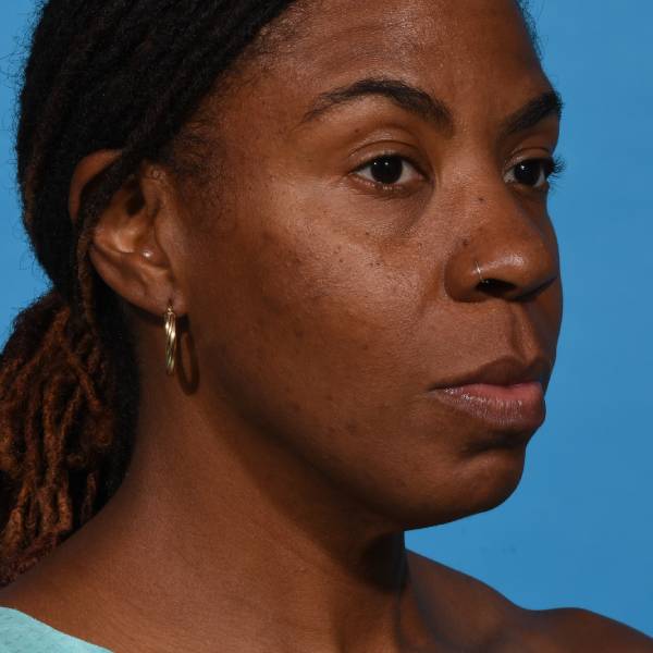 before rhinoplasty right angle view female patient case 1228