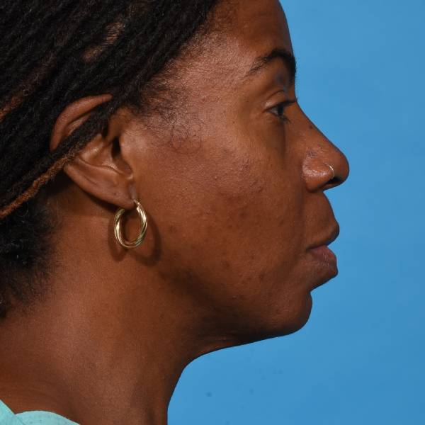 before rhinoplasty right side view female patient case 1228