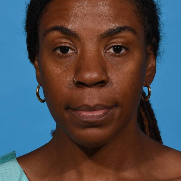 before rhinoplasty front view female patient case 1228