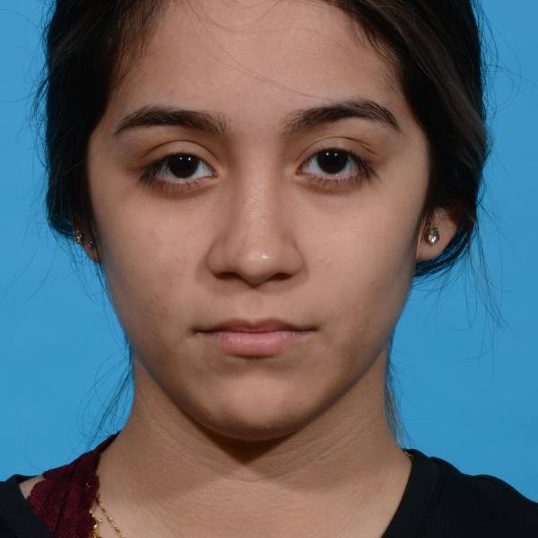 after rhinoplasty front view female patient case 1236