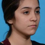 after rhinoplasty right angle view female patient case 1236