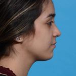 after rhinoplasty right side view female patient case 1236