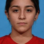 before rhinoplasty front view female patient case 1236