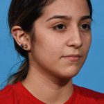 before rhinoplasty right angle view female patient case 1236