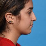 before rhinoplasty right side view female patient case 1236