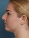 before rhinoplasty left side view female patient case 1685