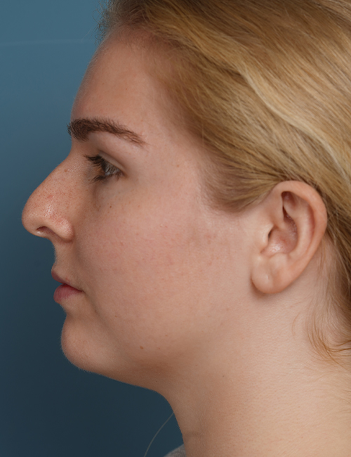 before rhinoplasty left side view female patient case 1685