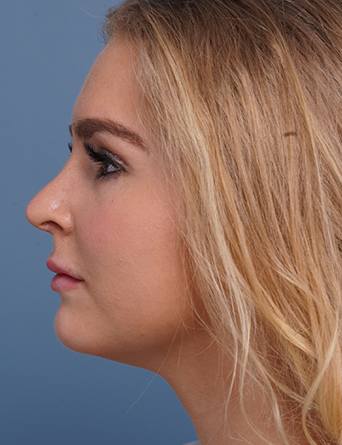 after rhinoplasty left side view female patient case 1685