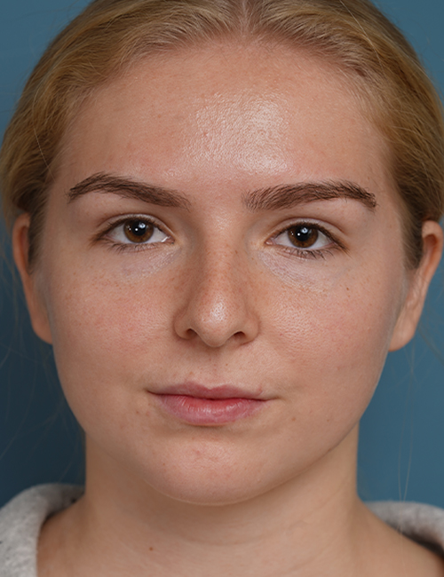 before rhinoplasty front view female patient case 1685