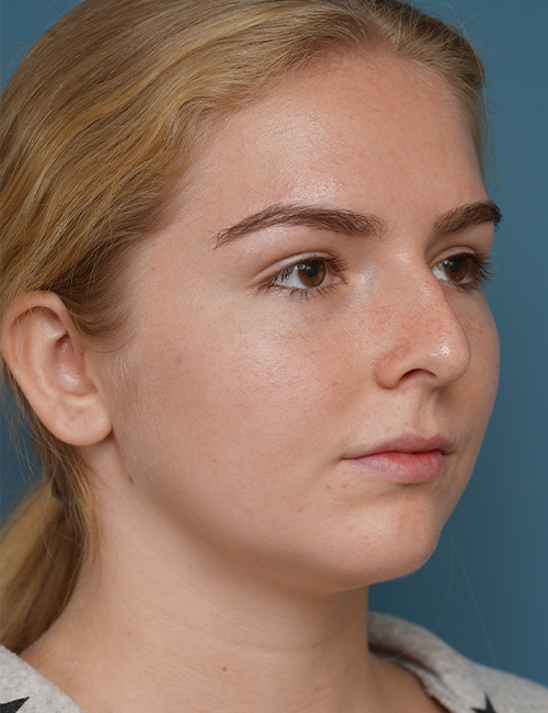 before rhinoplasty right angle view female patient case 1685