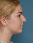 before rhinoplasty right side view female patient case 1685