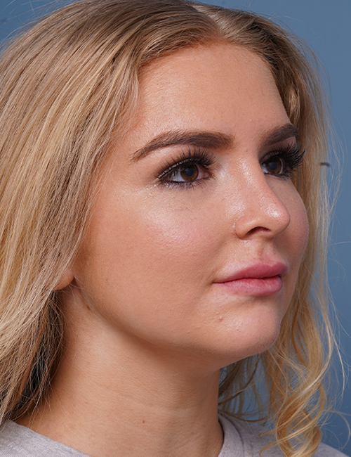 after rhinoplasty right angle view female patient case 1685