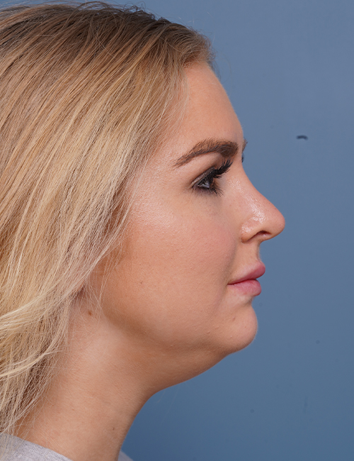 after rhinoplasty right side view female patient case 1685
