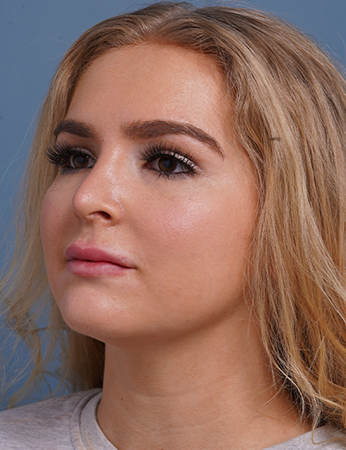 after rhinoplasty left angle view female patient case 1685