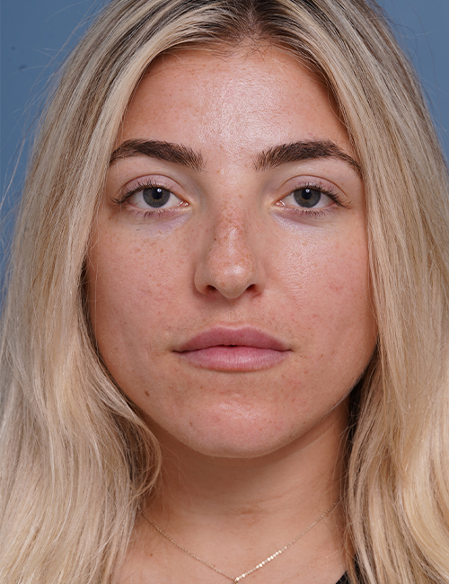 before rhinoplasty front view female patient case 1698