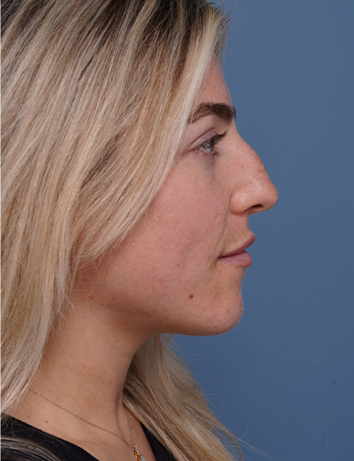 before rhinoplasty right side view female patient case 1698
