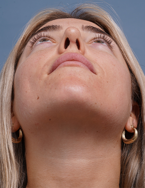 after rhinoplasty front head up view female patient case 1698