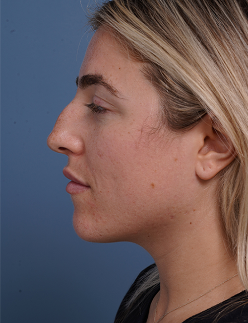 before rhinoplasty left side view female patient case 1698