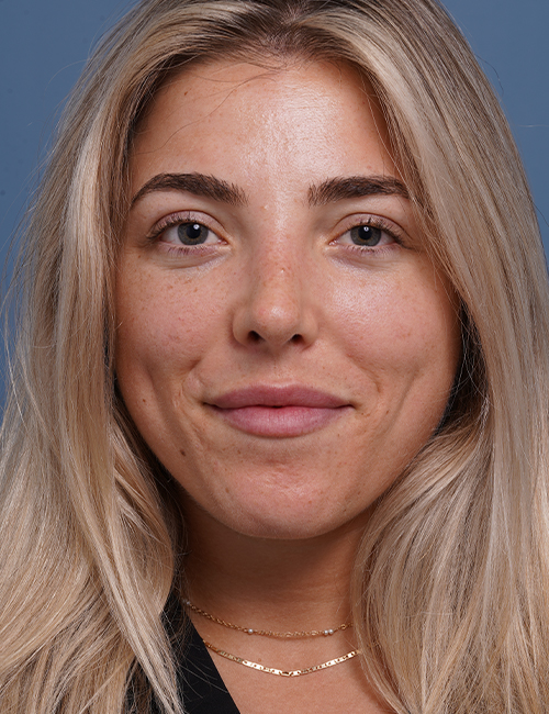 after rhinoplasty front view female patient case 1698