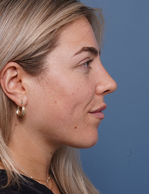 after rhinoplasty right side view female patient case 1698