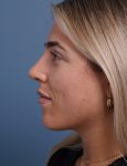 after rhinoplasty left side view female patient case 1698