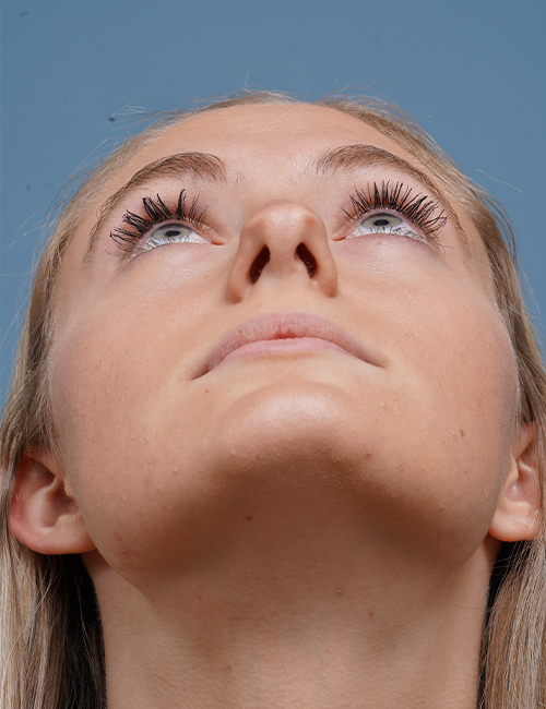 before rhinoplasty front heads up view female patient case 1711