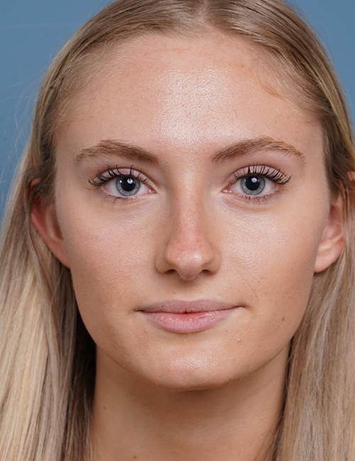 before rhinoplasty front view female patient case 1711