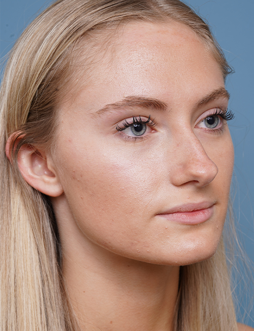 before rhinoplasty right angle view female patient case 1711