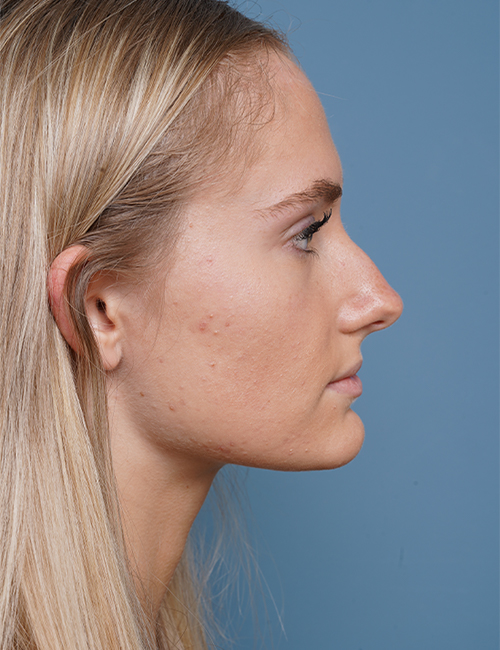 before rhinoplasty right side view female patient case 1711