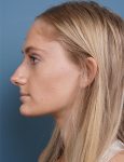 before rhinoplasty left side view female patient case 1711