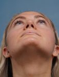 after rhinoplasty front heads up view female patient case 1711
