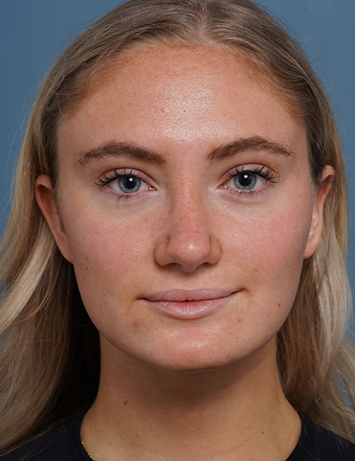 after rhinoplasty front view female patient case 1711